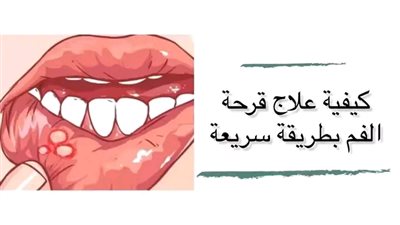 كيفيه علاج قرحه الفم بطريقه سريعة