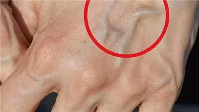 لماذا تظهر عروق بعض الناس من الجلد وتختفي عند آخرين